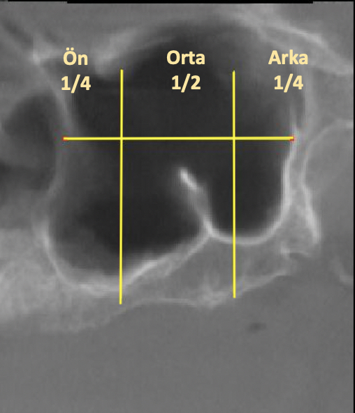 Assessment of Maxillary Sinus Septa Using Cone Beam Computed Tomography ...