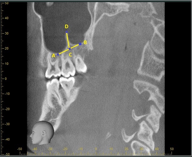Assessment of Maxillary Sinus Septa Using Cone Beam Computed Tomography ...